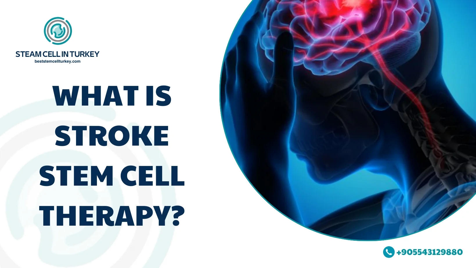 Stroke Stem Cell Therapy Cost